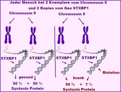 STXBP1 Syndrom